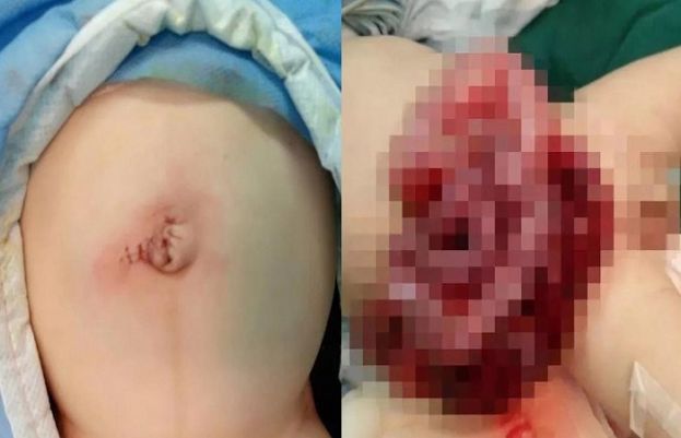 Infant’s intestines start spilling out of stomach after father cuts small hole in belly button