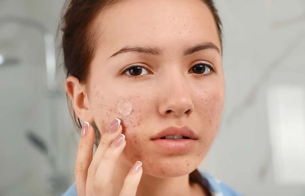 7 soothing home remedies for acne