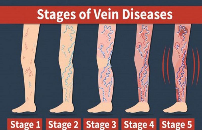 How Wearing Compression Stockings Can Help Your Varicose Veins