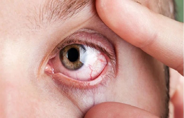 5 untrue chronic dry eye &#039;facts&#039;