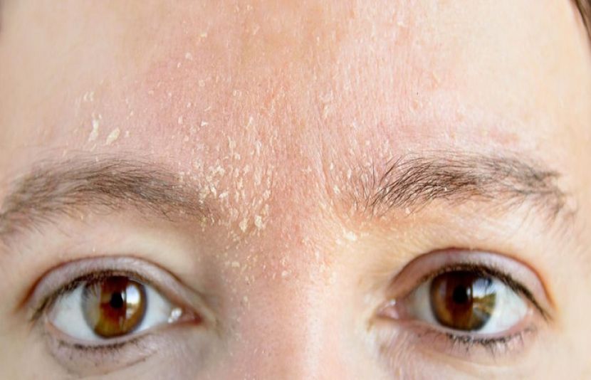 موسم سرما میں بہت سے لوگ چہرے اور سر کی جلد بھی خشکی اور مختلف مسائل کا شکار ہوجاتی ہے۔